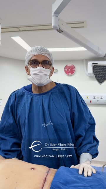 Trago direto do centro cirúrgico, a transformação por trás do Protocolo Lótus.

Unimos a lipoaspiração, a prótese de mama e a cirurgia abdominal em um único planejamento, entregando uma silhueta harmônica com segurança. 

Nossa prioridade é resgatar a autoestima e garantir que você se sinta segura em cada etapa. O seu sonho merece ser tratado com esse nível de cuidado.

Dr. Euler Ribeiro Filho
CRM 4501/AM | RQE 1477
Cirurgião Plástico